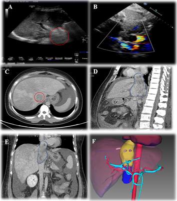 Ex Vivo Liver Resection and Autotransplantation as Surgical Option for Zone II–III Leiomyosarcoma of IVC: A Case Report and Literature Review